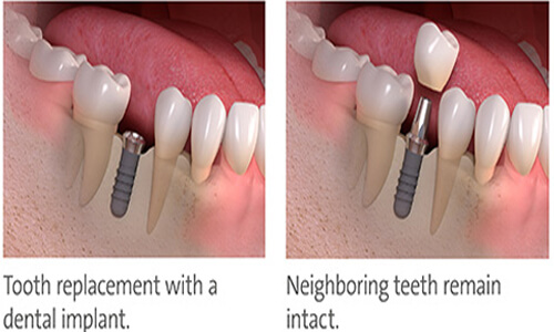 Illustration of a crowns for dental implant procedure done by the Costa Rica Dental Center in San Jose, Costa Rica.  The picture shows a dental implant placed in the lower jaw with a crown being placed over it.