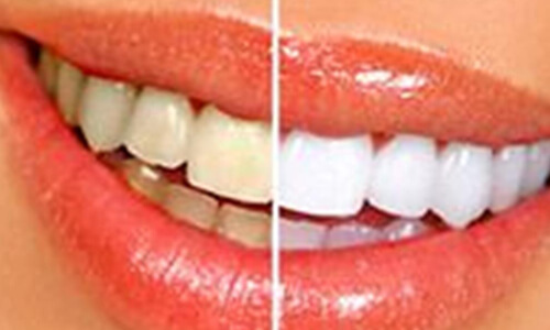 Picture of a dental whitening procedure done by the Costa Rica Dental Center in San Jose, Costa Rica.  The picture shows the difference between unwhitened and whitened upper teeth.