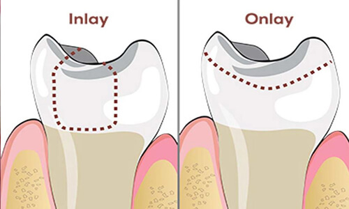 Illustration of a dental inlays/onlays procedure done by the Costa Rica Dental Center in San Jose, Costa Rica.  The picture shows two teeth, one with an inlay and the other with an onlay.