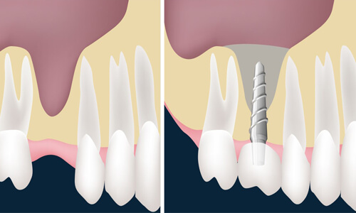 Illustration of a sinus lift procedure done by the Costa Rica Dental Center in San Jose, Costa Rica.  The picture shows a sinus lift being performed in the upper jaw.